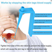 Stops Blood Supply to Skin Tags – Painless Method