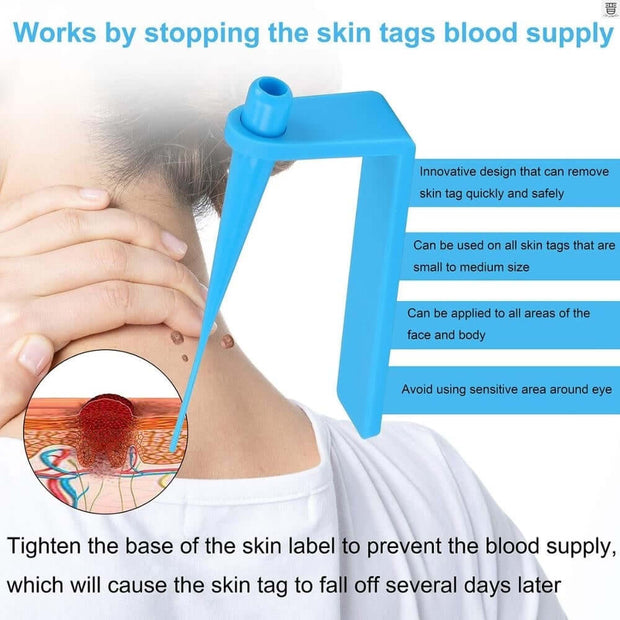 Stops Blood Supply to Skin Tags – Painless Method
