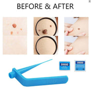Visible Results with Skin Tag Removal Tool